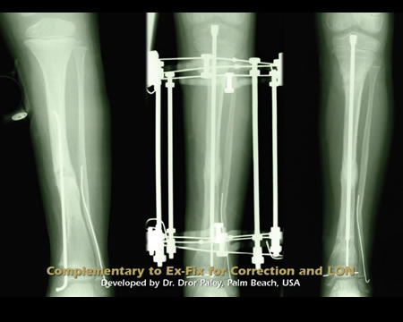 Fassier Duval - Kit for Osteogenesis Imperfecta Tibial nailing - Tibial Pseudoarthrosis
