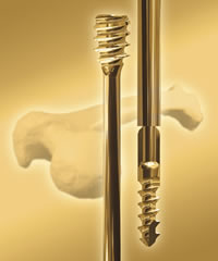 Fassier Duval - Kit for Osteogenesis Imperfecta Tibial nailing - femoral nailing - humeral nailing